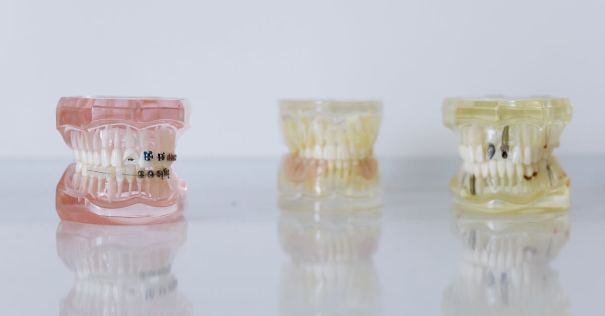 découvrez les implants dentaires, une solution efficace pour remplacer les dents manquantes. profitez d'un sourire radieux et d'une fonctionnalité dentaire retrouvée grâce à cette technologie avancée. en savoir plus sur les avantages, le processus et les soins associés aux implants dentaires.