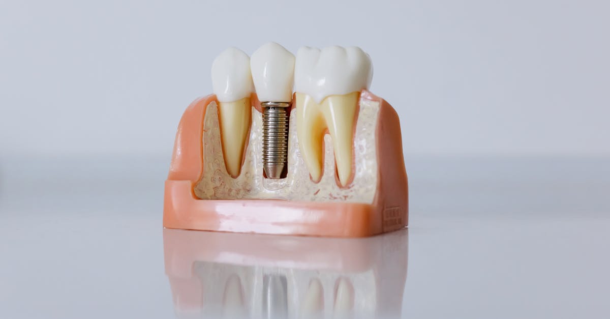 découvrez tout sur les implants dentaires : une solution efficace pour remplacer les dents manquantes et retrouver un sourire éclatant. informez-vous sur les techniques, les avantages et les soins post-opératoires.