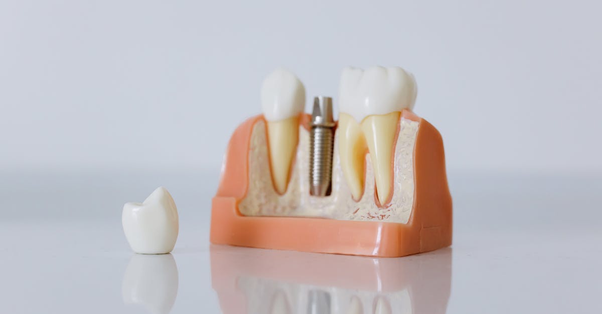 découvrez tout ce qu'il faut savoir sur les implants dentaires : procédures, avantages, coût et entretien. offrez-vous un sourire éclatant et durable grâce aux solutions modernes en dentisterie.