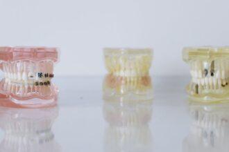 découvrez tout ce que vous devez savoir sur les implants dentaires : une solution durable pour restaurer votre sourire. apprenez les étapes du processus, les avantages, et comment choisir le bon praticien pour une expérience réussie.
