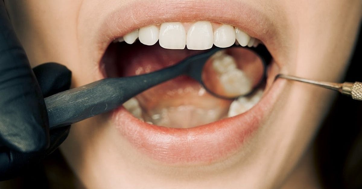 découvrez les facettes dentaires, une solution esthétique pour sublimer votre sourire. apprenez comment elles peuvent corriger les imperfections, masquer les taches et offrir un aspect naturel à vos dents. transformez votre sourire dès aujourd'hui!